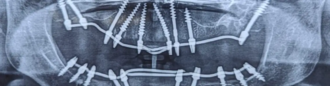 best basal implants, dental implants in punjabi bagh and rajouri garden by dental world