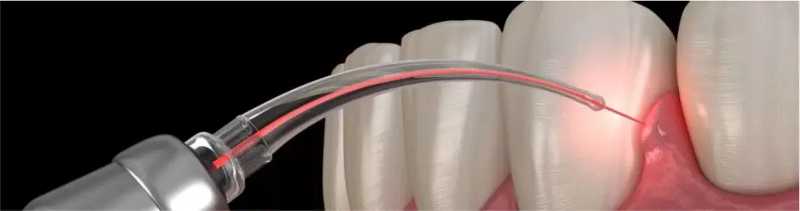 periodontics and gums treatments by dental world in punjabi bagh and rajouri garden