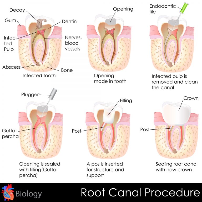 Root Canal Treatment Procedures