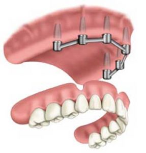 Dental Implants