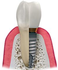 dental implants