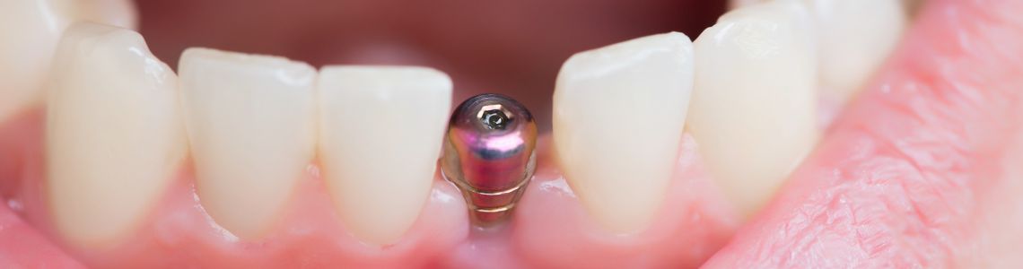 dental implants
