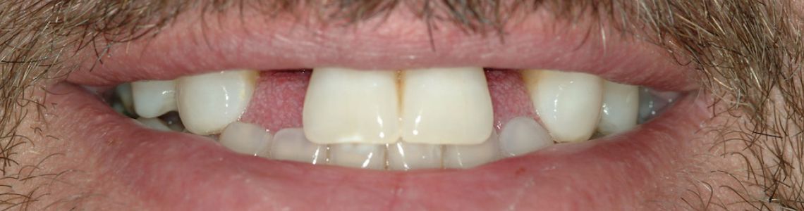 Dental Bridges Treatment In Delhi