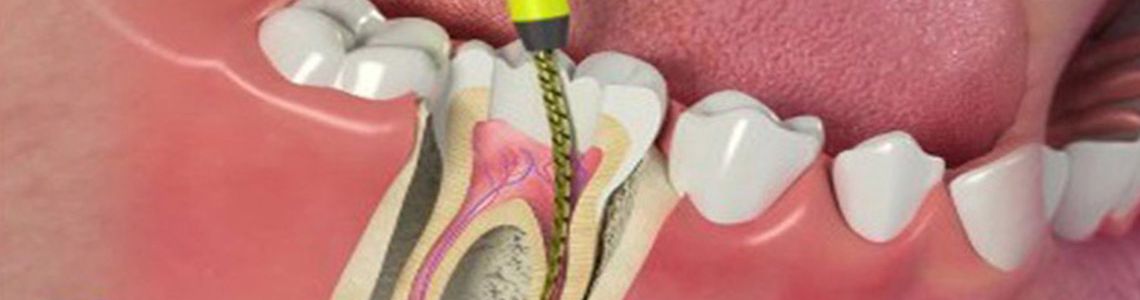 Root Canal Treatment In Delhi