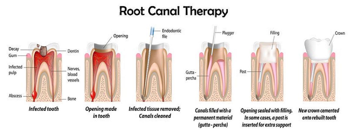 Root Canal Therapy In Delhi