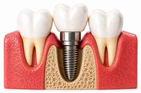 Dental Implants