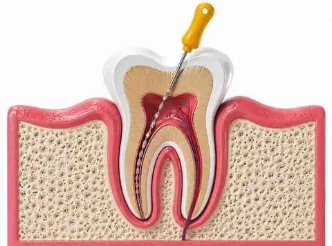 Root Canal Treatment